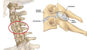 Diagram showing acute wry neck with highlighted facet joints in the cervical spine, indicating areas of pain and stiffness 