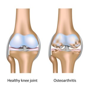 Healthy Knee vs. Osteoarthritis-Affected Knee Comparison