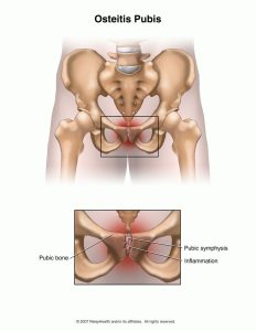 Osteitis Pubis Overview: Symptoms and Treatment Options 