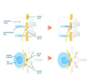 Diagram of lumbar disc injuries showing affected spinal areas and physiotherapy treatment methods.