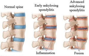 Comparison of Healthy Spine vs. Ankylosing Spondylitis Spine