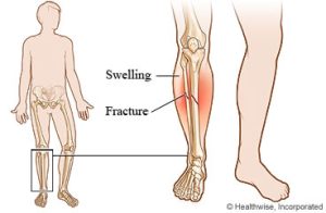 Child receiving physiotherapy for injuries, showcasing expert care at Move Forward Physio. 