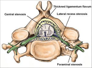 Types of Spinal Stenosis: Central, Foraminal, Lateral Recess