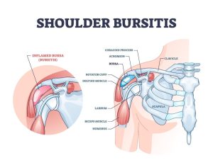 Inflamed Bursa in Shoulder