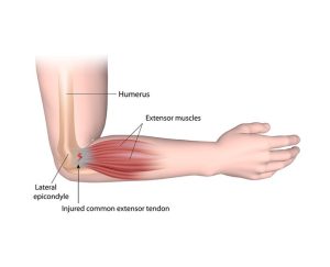 Illustration of tennis elbow treatment methods and exercises. Learn how to manage and prevent tennis elbow pain with these expert tips. 