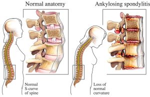 Anatomy Comparison: Healthy Spine vs. Ankylosing Spondylitis