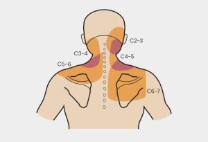 Diagram of Cervical Zygapophyseal Joint Pain Patterns