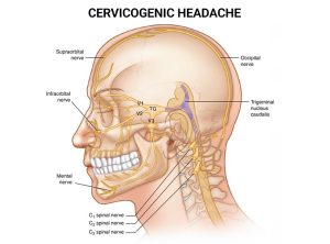 Pearsall physiotherapist offering effective treatment for cervicogenic headaches. Find relief and improve your quality of life. 