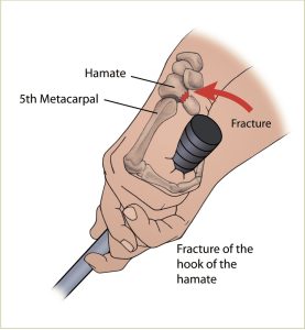 Understand Hamate fractures, their symptoms, and available treatments. Discover recovery strategies to promote healing and restore wrist function effectively. 