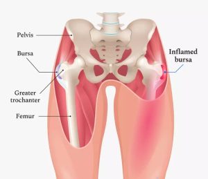 Internal view of hip showing inflammation of the trochanteric bursa