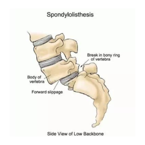 Overview of Lumbar Spondylolisthesis treatment options in Hocking. 