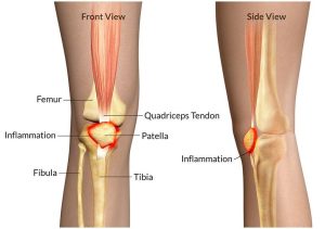 Patello-Femoral Joint Pain & Knee Pain Relief Solutions 