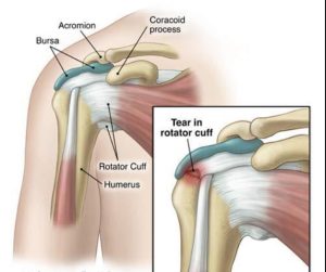 Learn about rotator cuff injuries, from tendinitis to tears, and discover treatment, rehab, and surgical options for effective recovery.