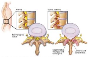 Internal View of Spinal Stenosis