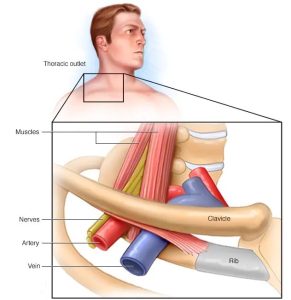 Diagram showing anatomy and symptoms of Thoracic Inlet Syndrome, highlighting areas of discomfort and treatment options