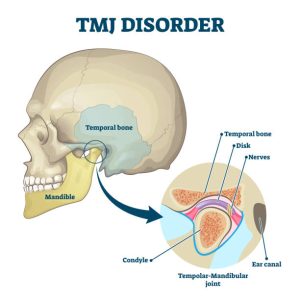 Image illustrating Temporomandibular Joint (TMJ) issues. Learn about TMJ disorders, symptoms, and effective treatments for jaw pain relief.