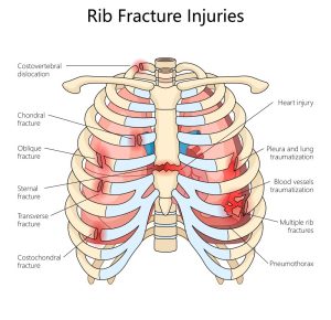 Internal Diagram of Chest Showing Rib Fractures