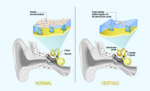 Diagram comparing a normal inner ear with one affected by vertigo, highlighting changes in balance structures and symptoms