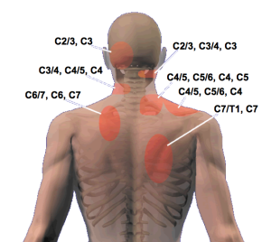 Discover whiplash injury treatments and recovery options at Move Forward Physio in Yanchep. 